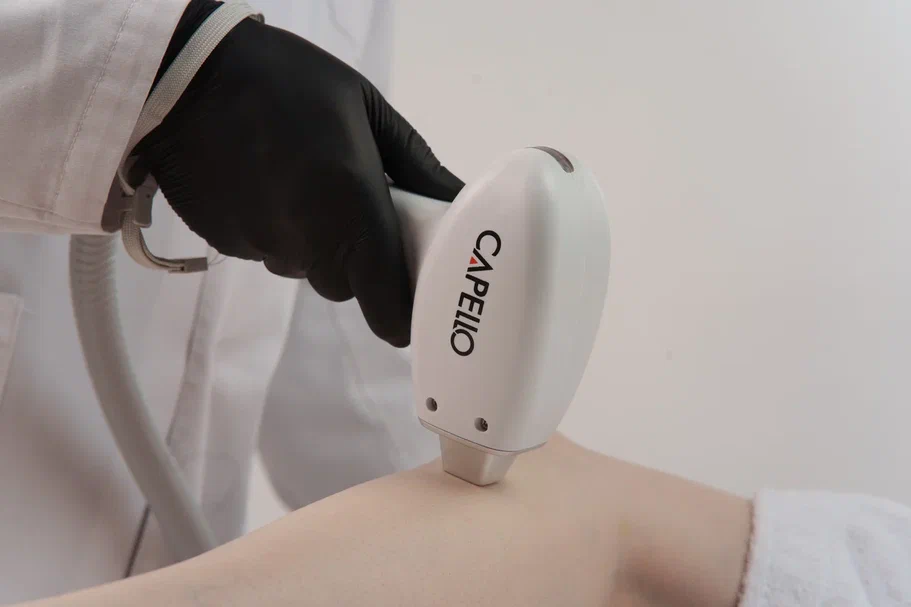 Диодный лазер для эпиляции