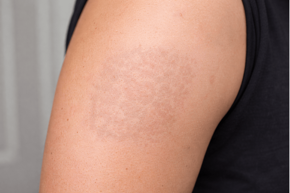 Как удалить тату