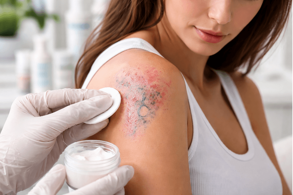 Как удалить тату